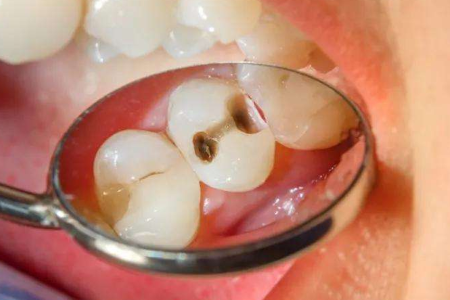 Babio lance un moyen d'enrichissement avancé de caries pour la détection précoce de la carie dentaire